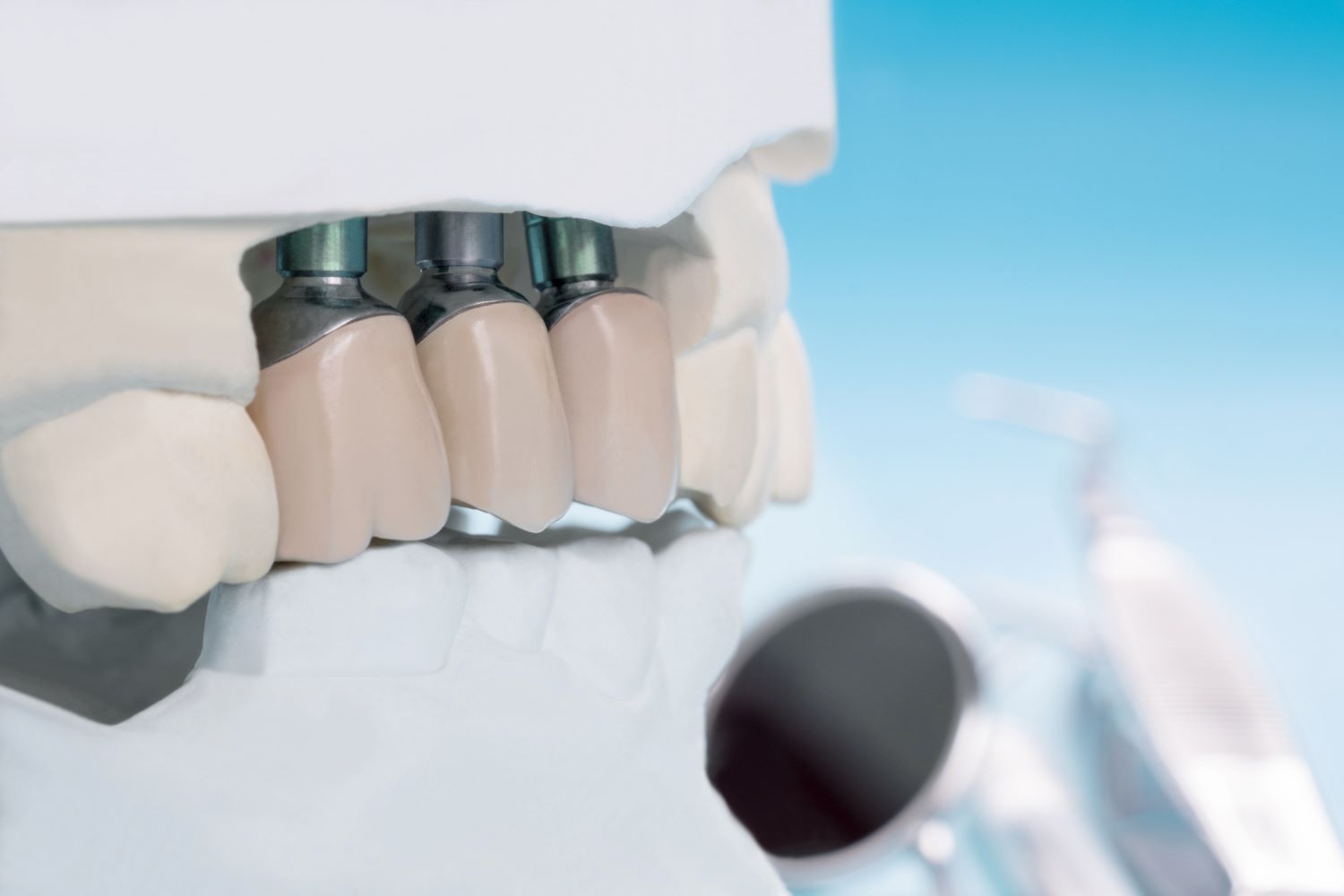Protetyka stomatologiczna to dziedzina medycyny, która zajmuje się uzupełnianiem braków w uzębieniu pacjentów