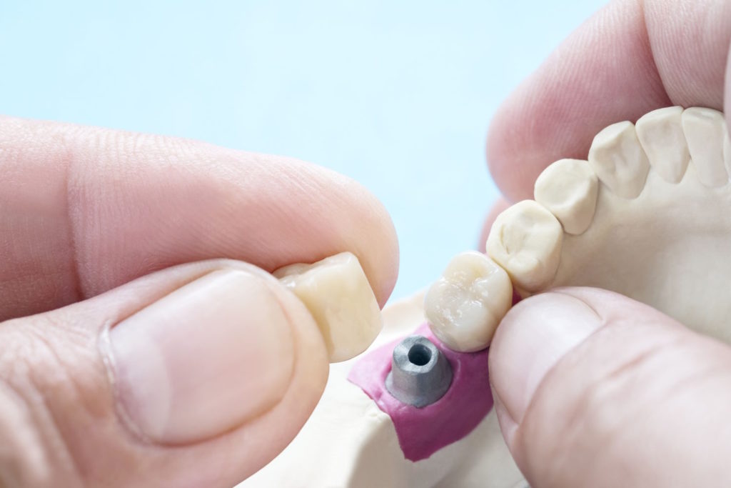 Protezy zębowe są doskonałym rozwiązaniem dla osób, które borykają się z brakiem kilku lub wszystkich zębów